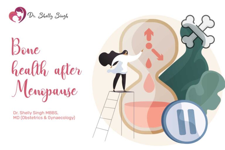 Bone health after Menopause