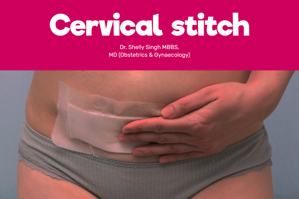Cervical stitch