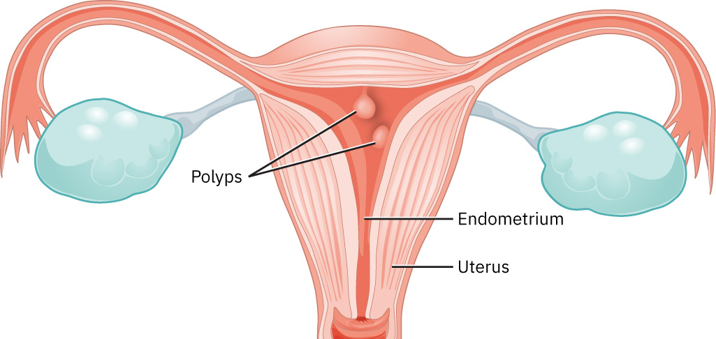  Expert hysteroscopic polypectomy in new Delhi
