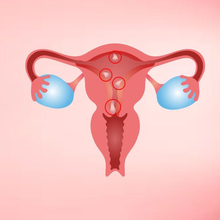  Expert hysteroscopic polypectomy in new Delhi
