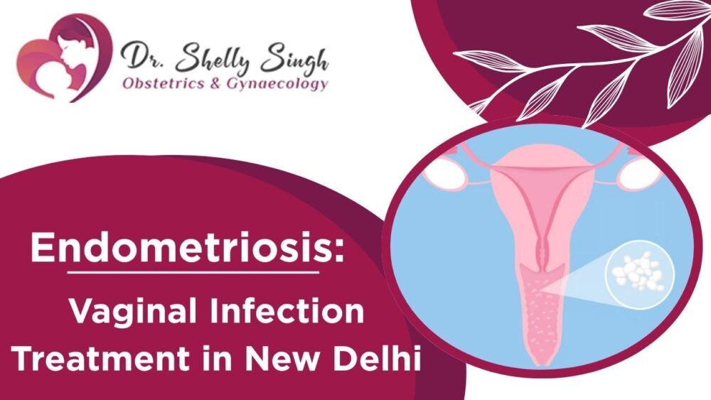 vaginal infection treatment in New Delhi