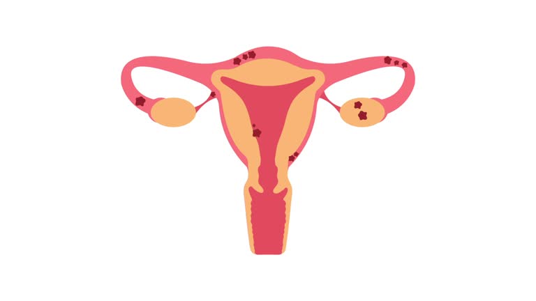 expert endometriosis specialist in New Delhi 
