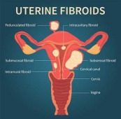 Fibroids treatment